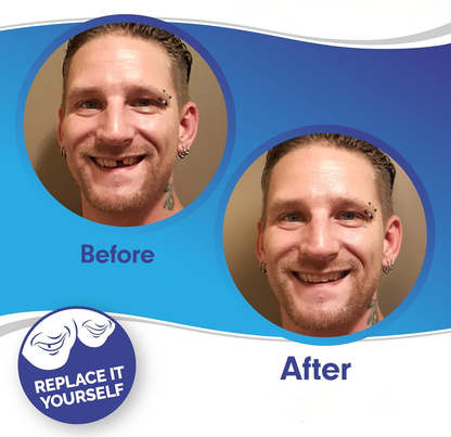 Nzmarket Snap-On Veneers – Top & Bottom Set Included