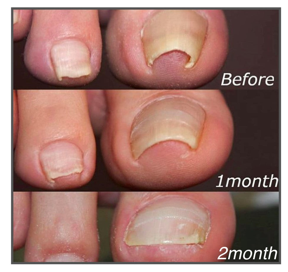Nzmarket Corrective Patches for Ingrown & Curved Nails