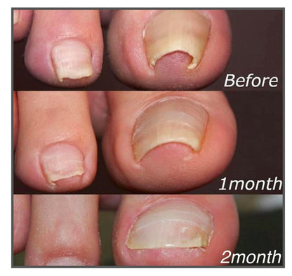 Nzmarket Corrective Patches for Ingrown & Curved Nails
