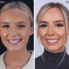 Instant Smile Cosmetic Teeth Set - Top & Bottom Veneer Look