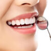 Instant Smile Cosmetic Teeth Set - Top & Bottom Veneer Look
