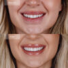 Instant Smile Cosmetic Teeth Set - Top & Bottom Veneer Look